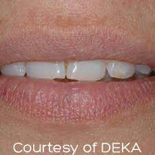 If you have cherry angiomas, you might try some cherry angioma home remedies. Cherry Angioma Removal Kent Red Spots Treatment Tunbridge Wells