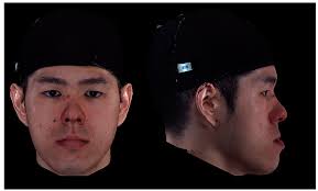 Facial Appearance and Psychosocial Features in Orthognathic Surgery: A  FACE-Q- and 3D Facial Image-Based Comparative Study of Patient-,  Clinician-, and Lay-Observer-Reported Outcomes