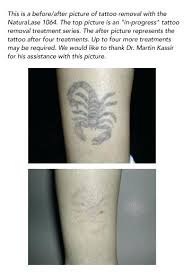 Another thing that can effect the cost of tattoo removal is the. Have A Does It Tattoo Cost To Much Removed How