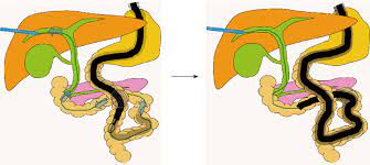 (1)makuuchi m, bandai y, ito t, et al. Insertion With Percutaneous Transhepatic Biliary Drainage Rendezvous Download Scientific Diagram