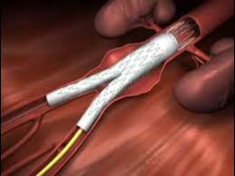 Aneurisma esplénico, ruptura, resección, complicación. Xii 38 Aneurisma De Aorta Terapeutica Endovascular Dr M Cerezo Youtube
