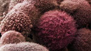 A new blood test may be able to accurately detect pancreatic cancer at its earliest stages, when it is most likely we put a lot of work up front into developing this model … to try to rigorously recapitulate how human. Pancreatic Cancer Blood Test Breakthrough Bbc News