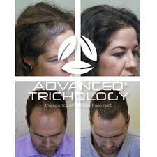Saw palmetto is one of the most popular natural treatments for hair loss and with just a quick search online you can see thousands of articles about it. Dht Blocker With Immune Support Supplement High Potency Saw Palmetto Green Tea And Probiotics 120 Count Bottle By Advanced Trich Technology Amazon De Beauty