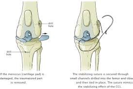Cranial Cruciate Ligament Repair Extracapsular Repair Ecls Click The Photo To Learn More About The Cruciate Ligament In Dogs Cruciate Ligament Pet Health