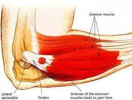 Tennis elbow, or lateral epicondylitis, is a painful condition of the elbow caused by overuse. Lateral Epicondylitis Active Care Physiotherapy Clinic