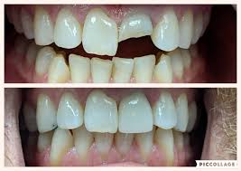Invisalign Dentist in Hartford CT, Best Invisible Aligners, Invisalign with  Crowns