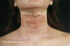 We did not find results for: Atopische Dermatitis Ubersicht Altmeyers Enzyklopadie Fachbereich Dermatologie