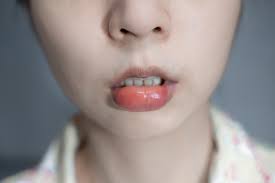 Swollen Lips After Dental Work Or Dental Cleaning Dr Gibberman