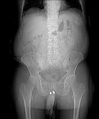 Make sure you discuss realistic expectations for. Penile Implant Radiology Case Radiopaedia Org