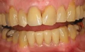 Partial dentures costs types faq pictures authority. Smile Gallery Village Dental