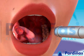 Image result for dental cancer