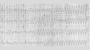 Vtach and vfib (ventricular tachycardia and fibrillation). Torsades De Pointes Symptoms Causes Treatment And More