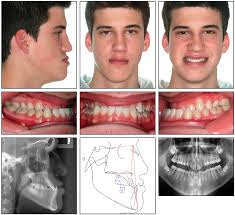 It can take anywhere from 18 months to 3 years to correct a crossbite. Nonsurgical Correction Of Severe Skeletal Class Iii Malocclusion Jco Online Journal Of Clinical Orthodontics