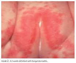 Image result for diaper dermatitis