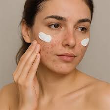 Cách trị mụn đỏ 2 bên má tại nhà đơn giản, hiệu quả cấp tốc