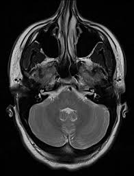 Image result for deviated septum