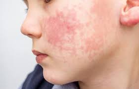 Experts say it isn't infectious but health image: Monkeypox What Is It