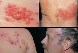 Shingles Rash Pictures Symptoms Vaccine Facts Shingles cartoon 1 of 23. shingles rash pictures symptoms