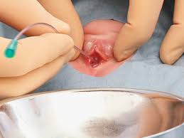 Catheterization of the Urethra in Girls | New England Journal of Medicine