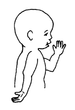 Maybe you would like to learn more about one of these? Disabled Village Children Chapter 14 Erb S Palsy