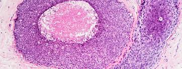 Tumor markers are substances made by cancer cells or by normal cells in response to cancer in the body. Metastatic Brain Tumors Johns Hopkins Medicine