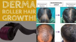 Derma roller to promote hair growth. Does Derma Roller Work For Hair Growth Youtube