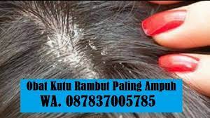 Kutu rambut merupakan parasit yang hidup di rambut dan kulit kepala manusia. Obat Kutu Rambut Ampuh Home Facebook