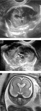 Fetal Brain Imaging A Comparison Between Magnetic Resonance Imaging And Dedicated Neurosonography Malinger 2004 Ultrasound In Obstetrics Amp Gynecology Wiley Online Library