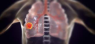 People may not react the way you anticipate or think they should react. people have different ways of processing the stressful news. Lung Cancer The Risk Factors Even Nonsmokers Must Know Johnson Johnson