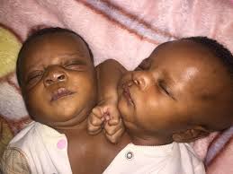 The girls are an incredible example of teamwork and compromise, as they. Two Girls One Body Bbc News