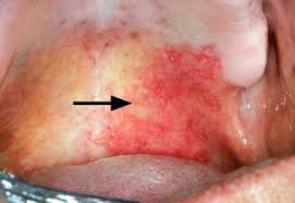 Image result for Erythroplakia roof of mouth