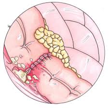 Colonic anastomotic leaks occur in the early or late postoperative phase, in which the enteric anastomosis fails. Anastomotic Leak Clinical Features Management Teachmesurgery
