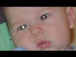 A vision check is especially important if there's a family history of crossed eyes, childhood cataracts or other eye conditions. à®• à®´à®¨ à®¤ à®¯ à®© à®•à®£ à®•à®³ à®'à®³ à®° à®¤ à®•à®µà®© à®™ à®• The Signs And Symptoms Of Eye Cancer à®• à®´à®¨ à®¤ à®¯ à®© à®•à®£ à®•à®³ à®'à®³ à®° à®¤ à®•à®µà®© à®™ à®• Tamil Boldsky