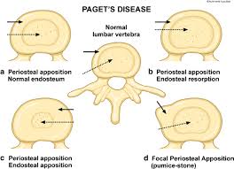 All vertebra artwork ships within 48 choose your favorite vertebra designs and purchase them as wall art, home decor, phone cases, tote. The Spine In Paget S Disease Springerlink