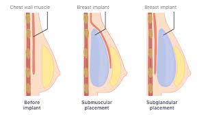 Allergan Breast Implants Textured Vs Smooth Surgery Risks