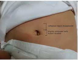 About My Lil Buds Baby Belly Button From Hernia Like To Normal Updated