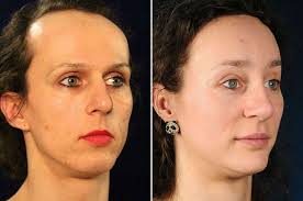 How to do forehead reduction surgery? Facial Feminization Surgery Hairline Lowering Surgery Creating A Feminine Hairline 2pass Clinic