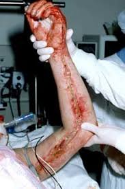 An escharotomy is an incision made completely through the depth of the burn eschar that usually occurs within the first day of the injury. Upper Limb Escharotomy However The Most Common Acute Surgical Download Scientific Diagram