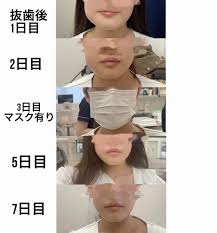 親知らずの抜歯 経過 | お知らせ（詳細）｜駅から徒歩1分の名古屋ウィズ歯科・矯正歯科