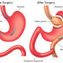 bariatric surgery from www.uclahealth.org