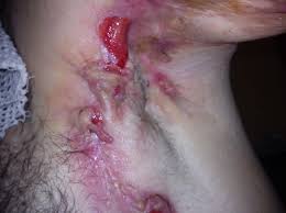 Hidradenitis Suppurativa Hs Kopek Memesi Nedir