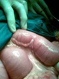 Other treatment options include somatostatin analogs, interferons, treatment of hepatic. Carcinoid Wikipedia