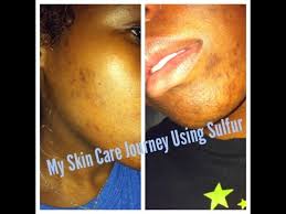 Nun gibt es für zahlungsschwierigkeiten niemals einen passenden zeitpunkt, doch der moment. De La Cruz Sulfur Ointment Journey Pt 1 W Pics Youtube