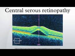 It occurs when fluid builds up in the macula, causing distorted and blurry vision. Central Serous Retinopathy Youtube