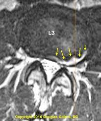 Annular Tear And Back Pain Advice By A World Renowned Spine Expert Chirogeek Com