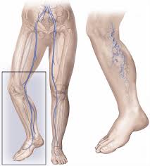 Maybe you would like to learn more about one of these? Varicose Veins Surgery Healthdirect