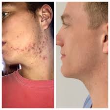 TOP 10 BEST Acne Treatment in Boise, ID