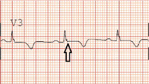 Image result for Epsilon Wave