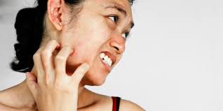 Tinea ditandai dengan beragam gejala, mulai dari bintik merah pada kulit disertai gatal, kulit yang tampak bersisik dan menebal, hingga timbulnya luka pada permukaan kulit. Keluar Bintik Merah Pada Kulit Itu Gejala Hives Merdeka Com