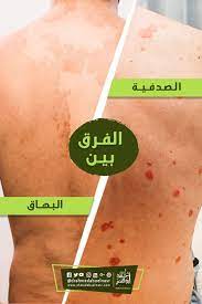 البهاق مرض جلدي غير معدي ويعرف بزوال لون الجلد على شكل بقع لونية بيضاءناتجه عن نقص هرمون الميلانين الص incoming call screenshot incoming call call screenshot